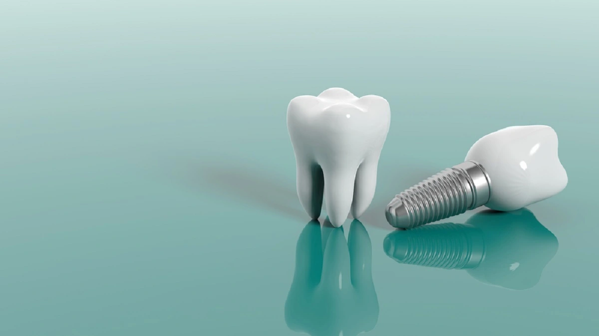 Dental Implants Covered by Medical Insurance
